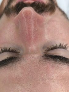 čištění pleti pro muže Opava,Hydrodermabraze Opava, hydrafacial Opava, hloubkové čištění Opava