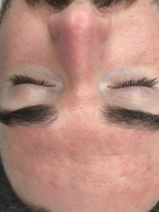 hydrodermabraze Opava, hydrafacial Opava, léčba akné Opava, čištění pleti